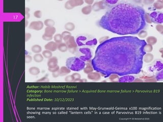 B19 Inside Inside the Cell: Parvovirus B19’s Cytological Signatures | PDF