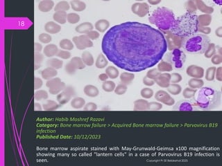 B19 Inside Inside the Cell: Parvovirus B19’s Cytological Signatures | PDF