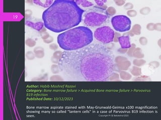 B19 Inside Inside the Cell: Parvovirus B19’s Cytological Signatures | PDF