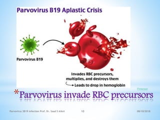 *Parvovirus invade RBC precursors
Pinterest
08/10/2018Parvovirus 3B19 infection Prof. Dr. Saad S AlAni 10
 