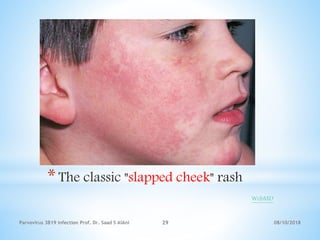 08/10/2018Parvovirus 3B19 infection Prof. Dr. Saad S AlAni 29
*The classic "slapped cheek" rash
WebMD
 