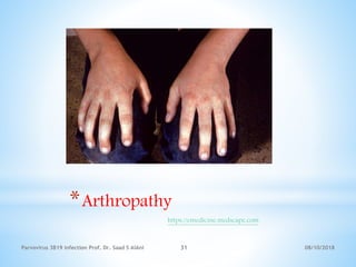 08/10/2018Parvovirus 3B19 infection Prof. Dr. Saad S AlAni 31
*Arthropathy
https://emedicine.medscape.com
 