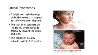 Parvovirus Reticlar Rash Parvoviruses | PPTX