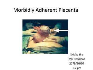 Morbidly Adherent Placenta
Kritika Jha
MD Resident
2079/10/04
1-2 pm
 