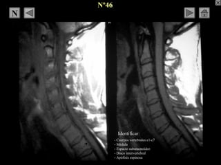 Nº46
- Cuerpos vertebrales c1-c7
- Médula
- Espacio subaracnoideo
- Disco intervertebral
- Apófisis espinosa
Identificar:
...