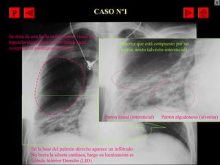 CASO Nº1
En la base del pulmón derecho aparece un infiltrado
No borra la silueta cardiaca, luego su localización es
Lóbulo...