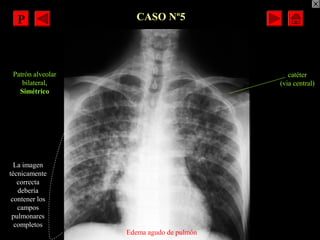 CASO Nº5
Patrón alveolar
bilateral,
Simétrico
catéter
(via central)
Edema agudo de pulmón
La imagen
técnicamente
correcta
...