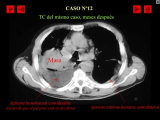 CASO Nº12
Masa
derrame homolateral considerable
(recuerda que el paciente está en decúbito) persiste mínimo derrame contra...