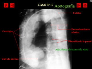 CASO Nº19
Aneurisma disecante de aorta
Aortografía
Ensanchamiento
aórtico
Disección de la pared
Catéter
Cerclajes
Válvula ...