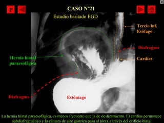 CASO Nº21
Estudio baritado EGD
Diafragma
Tercio inf.
Esófago
Estómago
Hernia hiatal
paraesofágica
Diafragma
Cardias
La her...