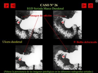 CASO Nº 26
Ulcera duodenal
EGD Seriada Marco Duodenal
Imagen de adición
Bulbo deformado
*
*
*
*
*
(Nótese la persistencia ...