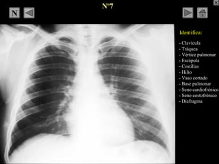- Clavícula
- Tráquea
- Vértice pulmonar
- Escápula
- Costillas
- Hilio
- Vaso cortado
- Base pulmonar
- Seno cardiofrénic...
