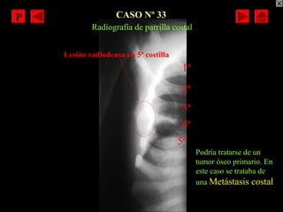 PPPP CASO Nº 33
Podría tratarse de un
tumor óseo primario. En
este caso se trataba de
una Metástasis costal
Radiografía de...