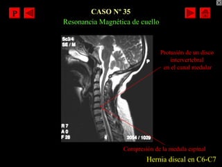 CASO Nº 35
Hernia discal en C6-C7
Protusión de un disco
intervertebral
en el canal medular
Resonancia Magnética de cuello
...