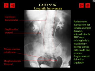 CASO Nº 36
Duplicación
ureteral
Desplazamiento
Ureteral
Urografía Intravenosa
Escoliosis
dorsolumbar
Mioma uterino
calcifi...