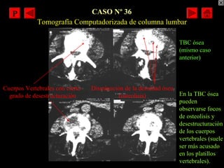 CASO Nº 36
Disminución de la densidad ósea
(osteolisis)
Cuerpos Vertebrales con cierto
grado de desestructuración
Tomograf...