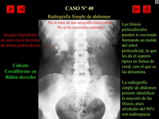 CASO Nº 40
Radiografía Simple de abdomen
Cálculo
Coraliforme en
Riñón derecho
Imagen hiperdensa
en zona renal derecha,
de ...