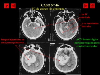CASO Nº 46
ACV hemorrágico
intraparenquimatoso
e intraventricular
Imagen hiperdensa en
zona parenquimatosa ...
TC de cráne...