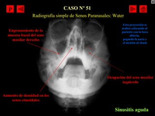 CASO Nº 51
Sinusitis aguda
Aumento de densidad en los
senos etmoidales
Ocupación del seno maxilar
izquierdo
Engrosamiento ...