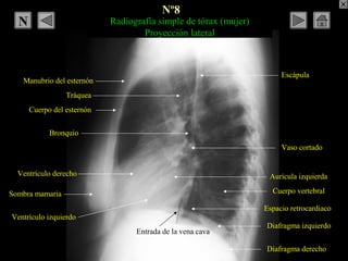 Radiografía simple de tórax (mujer)
Proyección lateral
Manubrio del esternón
Cuerpo del esternón
Bronquio
Escápula
Cuerpo ...