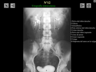 Urografía intravenosa
1 Pelvis del riñón derecho
2 Cálices
3 Infundíbulos
4 Polo inferior del riñón derecho
5 Uréter derec...