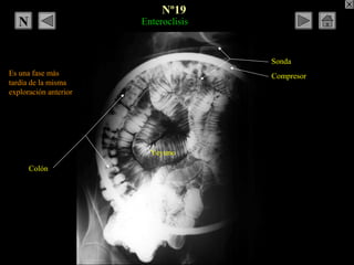Enteroclisis
Es una fase más
tardía de la misma
exploración anterior
Compresor
Sonda
Colón
Yeyuno
Nº19
NN
 