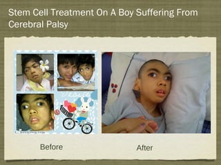 Stem Cell Treatment On A Boy Suffering From
Cerebral Palsy




                                 1




       Before                After
 