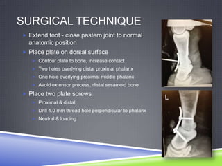 SURGICAL TECHNIQUE
 Extend foot - close pastern joint to normal
  anatomic position
 Place plate on dorsal surface
    Contour plate to bone, increase contact
    Two holes overlying distal proximal phalanx
    One hole overlying proximal middle phalanx
    Avoid extensor process, distal sesamoid bone

 Place two plate screws
    Proximal & distal
    Drill 4.0 mm thread hole perpendicular to phalanx
    Neutral & loading
 
