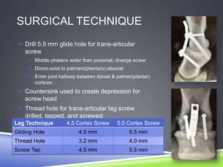 SURGICAL TECHNIQUE
  Drill 5.5 mm glide hole for trans-articular
    screw
      Middle phalanx wider than proximal; diverge screw
      Dorso-axial to palmaro(plantaro)-abaxial
      Enter joint halfway between dorsal & palmer(plantar)
        cortices
  Countersink used to create depression for
    screw head
  Thread hole for trans-articular lag screw
    drilled, tapped, and screwed
Lag Technique         4.5 Cortex Screw      5.5 Cortex Screw
Gliding Hole               4.5 mm                 5.5 mm
Thread Hole                3.2 mm                 4.0 mm
Screw Tap                  4.5 mm                 5.5 mm
 
