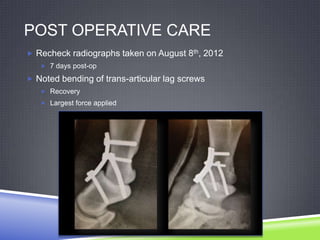POST OPERATIVE CARE
 Recheck radiographs taken on August 8th, 2012
    7 days post-op

 Noted bending of trans-articular lag screws
    Recovery
    Largest force applied
 