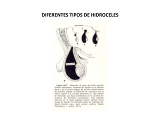 DIFERENTES TIPOS DE HIDROCELES
 