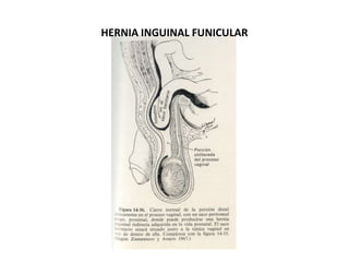 HERNIA INGUINAL FUNICULAR
 