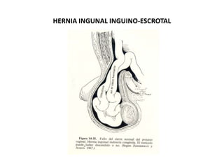 HERNIA INGUNAL INGUINO-ESCROTAL
 