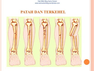 Hak Milik Blog Sains Sukan
     www.sainsukanblog.wordpress.com




PATAH DAN TERKEHEL
 