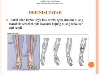 Hak Milik Blog Sains Sukan
                        www.sainsukanblog.wordpress.com




                  DEFINISI PATAH
    Patah ialah terputusnya kesinambungan struktur tulang
    manakala terkehel pula keadaan hujung tulang terkeluar
    dari sendi
 