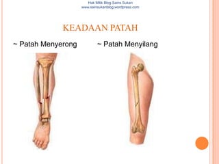 Hak Milik Blog Sains Sukan
                    www.sainsukanblog.wordpress.com




             KEADAAN PATAH
~ Patah Menyerong           ~ Patah Menyilang
 