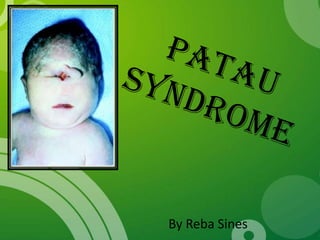 Patau Syndrome By Reba Sines 