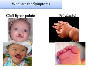 Whatare the Symptoms
Cleft lip or palate Polydactyl
 