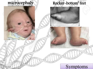 microcephaly Rocker-bottom’ feet
Symptoms
 