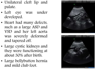 • Unilateral cleft lip and
palate.
• Left eye was under
developed.
• Heart had many defects,
such as a large ASD and
VSD and her left aorta
was severely deformed
and tapered off.
• Large cystic kidneys and
they were functioning at
about 30% after birth.
• Large bellybutton hernia
and mild club foot.
 