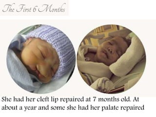 She had her cleft lip repaired at 7 months old. At
about a year and some she had her palate repaired
 