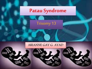 Trisomy 13
PatauSyndrome
ARIANNE GAY G. AYAD
 