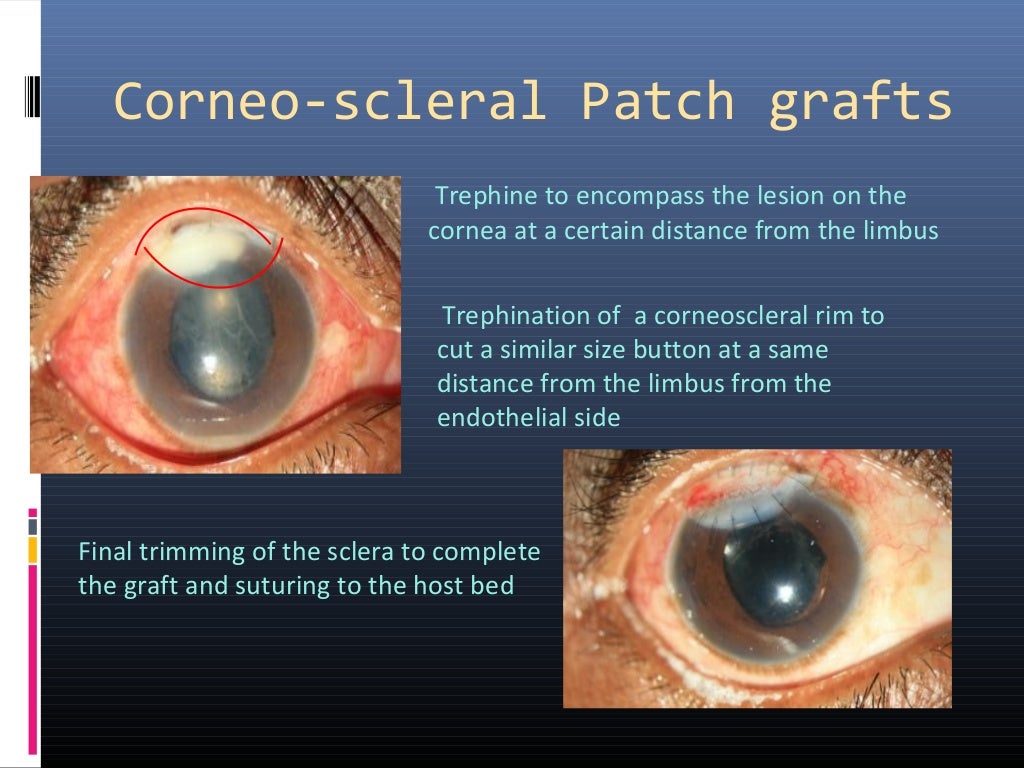 Patch Graft