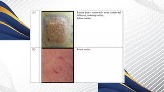 patch test in dermatology principle, indications | PPTX