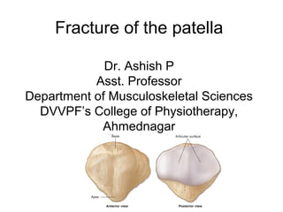 Fracture of the patella
Dr. Ashish P
Asst. Professor
Department of Musculoskeletal Sciences
DVVPF’s College of Physiotherapy,
Ahmednagar
 