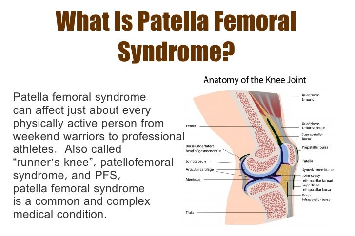 patella femoral syndrome a guide for runners patella femoral syndrome