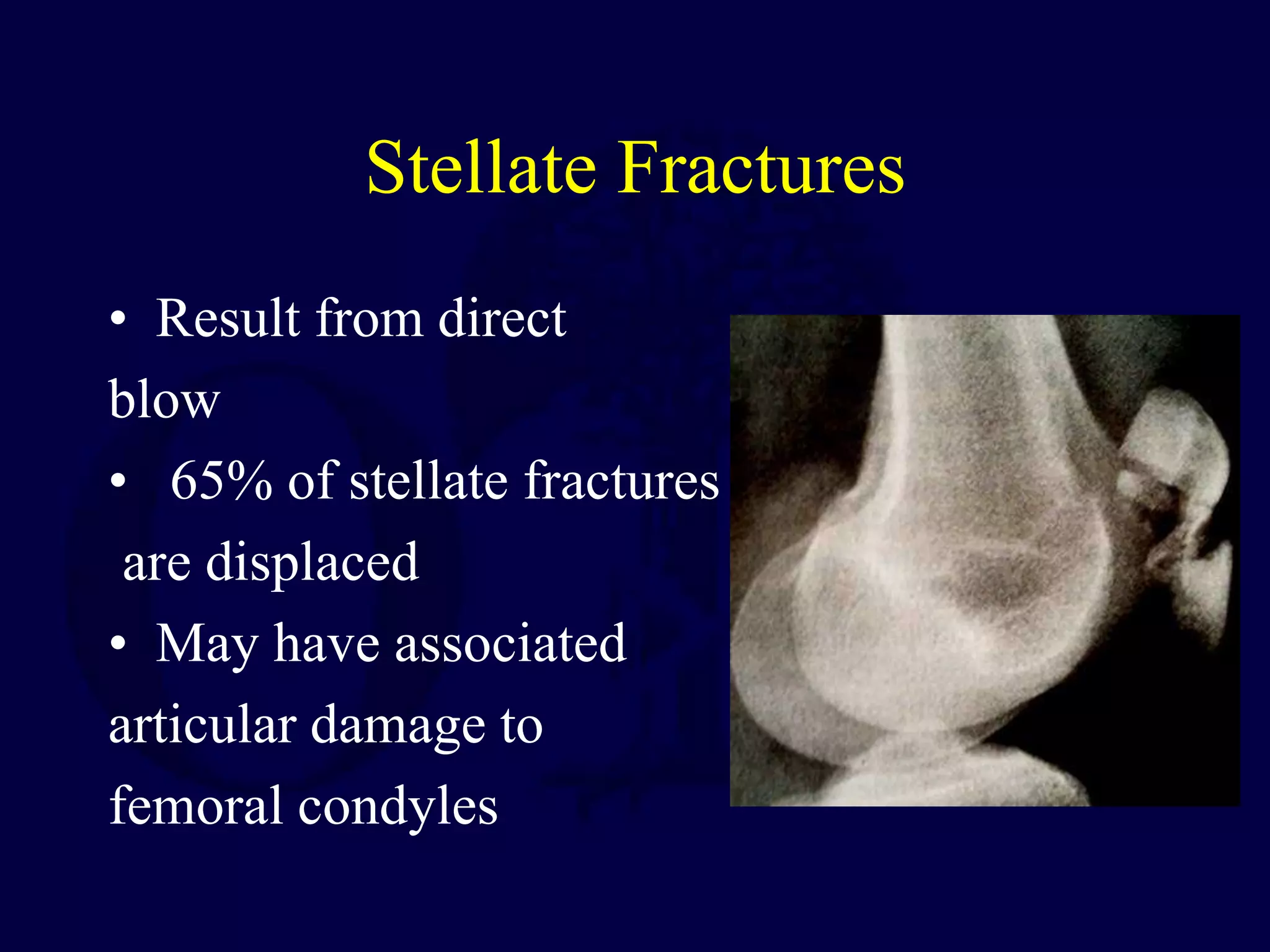 Stellate Fractures
• Result from direct
blow
• 65% of stellate fractures
are displaced
• May have associated
articular damage to
femoral condyles
 