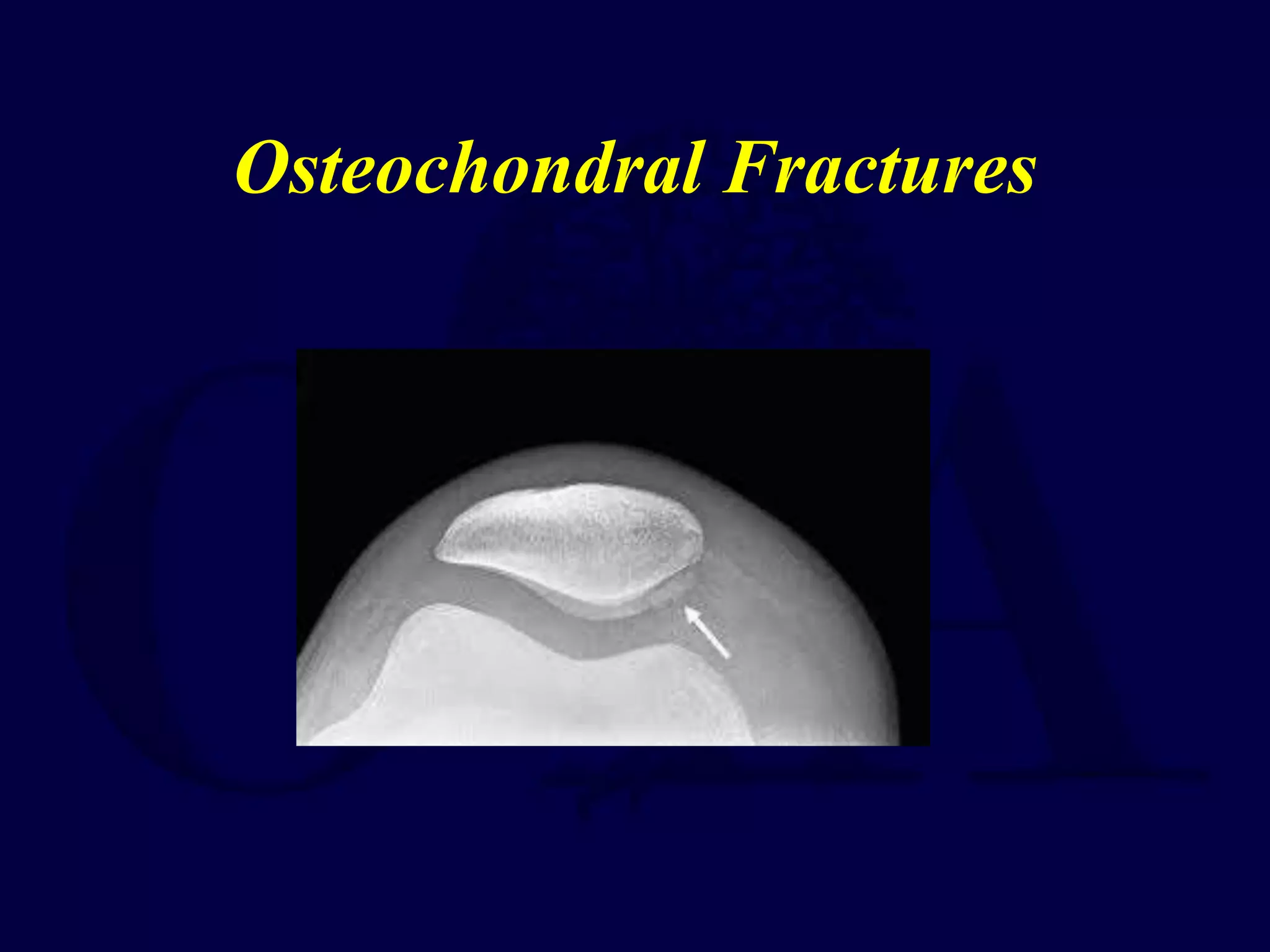 Osteochondral Fractures
 