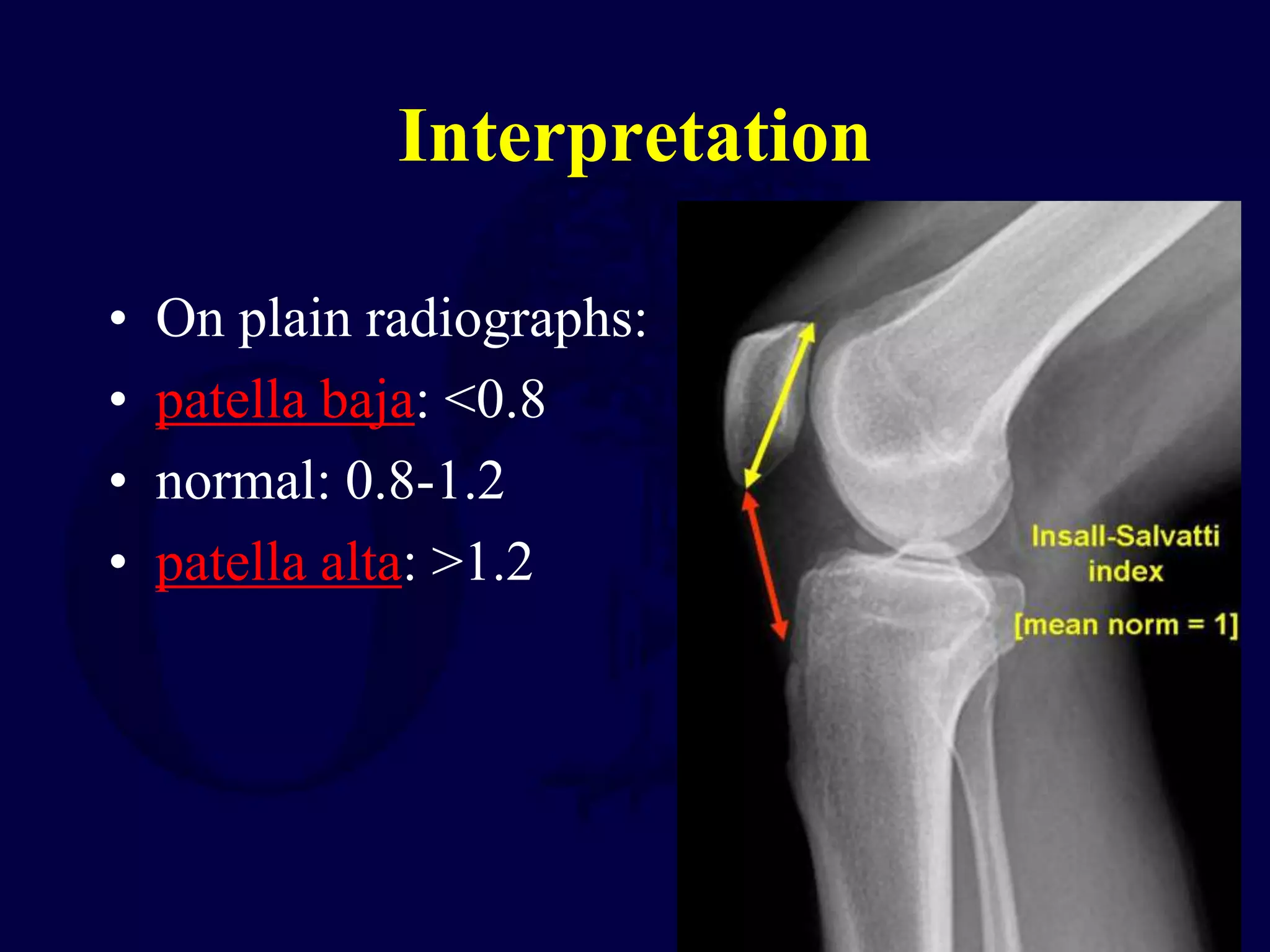 Interpretation
• On plain radiographs:
• patella baja: <0.8
• normal: 0.8-1.2
• patella alta: >1.2
 