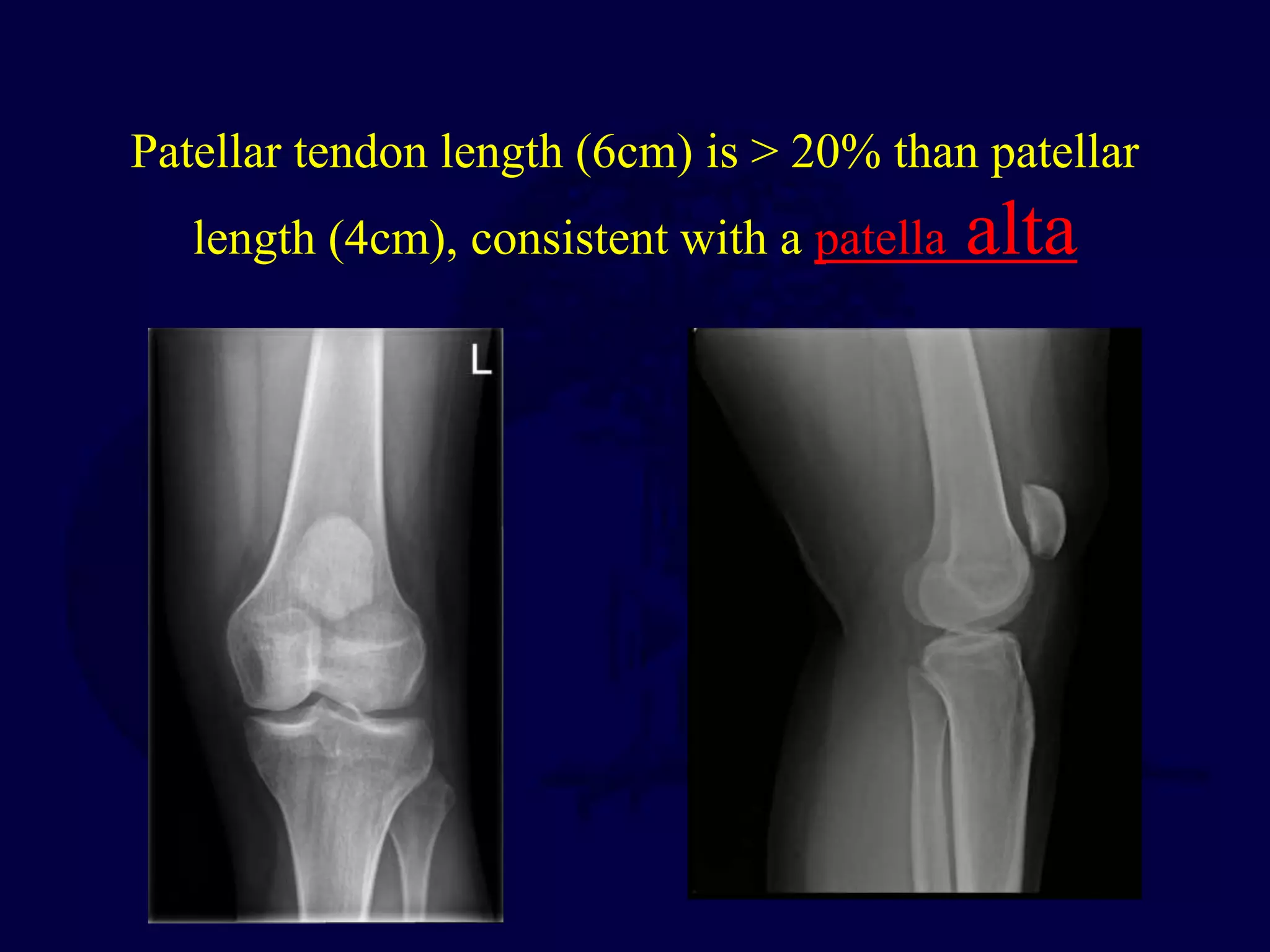 Patellar tendon length (6cm) is > 20% than patellar
length (4cm), consistent with a patella alta
 